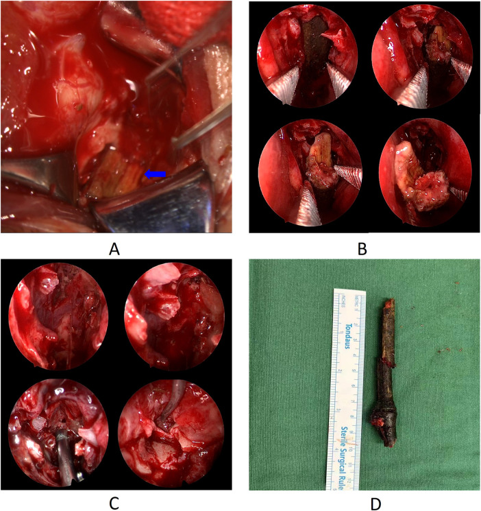 Intraoperative photograph showing the tip of the wooden foreign body in the orbit, endoscopic views of the stepwise extraction and of the cleared sinus cavity, and the extracted bamboo stick photographed beside a ruler