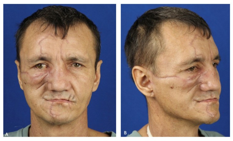 Front and three-quarter photographs of a man's face against a blue background, with healed scars across the forehead, right cheek, lips and chin, and drooping of the right side of the face.