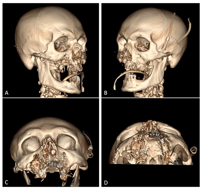 Four three-dimensional CT reconstructions of the skull after surgery, showing small metal plates and screws holding the cheekbone, nose and pieces of the upper jaw in place.