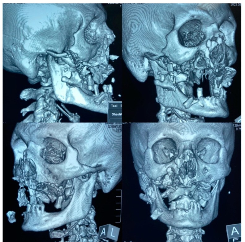 Four three-dimensional CT reconstructions of a skull seen from different angles, showing the bones of the middle of the face broken into many displaced fragments, with the upper jaw and teeth out of place.