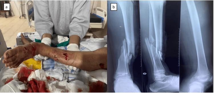 On the left, a photograph of the boy's left lower leg on a hospital bed, with bleeding bite wounds and a visible deformity. On the right, three X-rays of the lower leg showing both bones broken near the ankle and displaced.