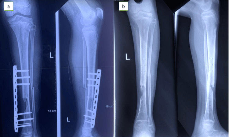 On the left, two X-rays of the lower leg with a metal plate lying outside the leg, held to the shin bone by screws above and below the fracture. On the right, two X-rays after the plate was removed, showing the bones aligned with new bone forming across the fracture.