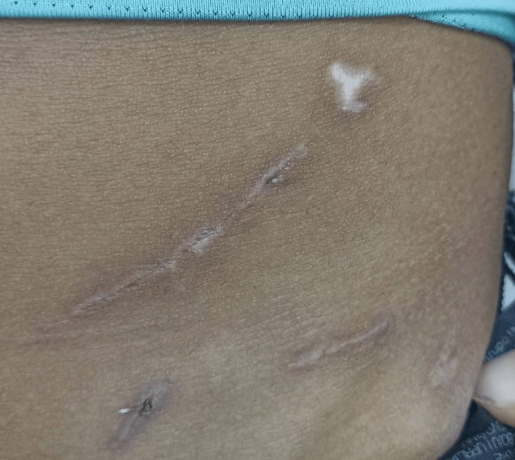 The skin of the abdomen showing a thin diagonal healed scar and smaller marks, with a light blue shirt pulled up above.