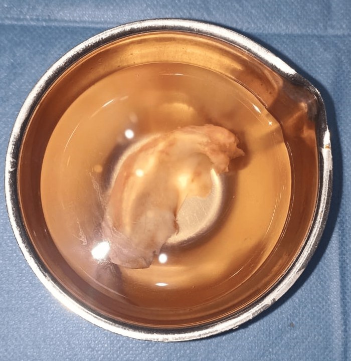 A small metal bowl of clear fluid on a blue drape, holding the curved, pale pink cartilage framework of an ear.