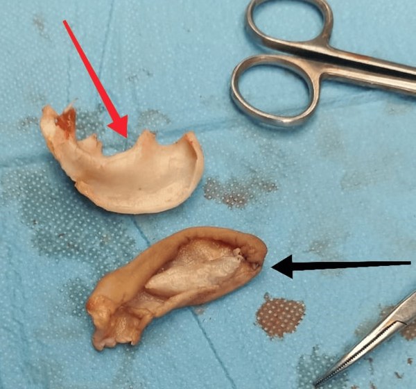 On a blue surgical drape, a pale curved piece of ear cartilage marked with a red arrow, and below it the skin and soft tissue removed from the ear, marked with a black arrow, next to surgical instruments.