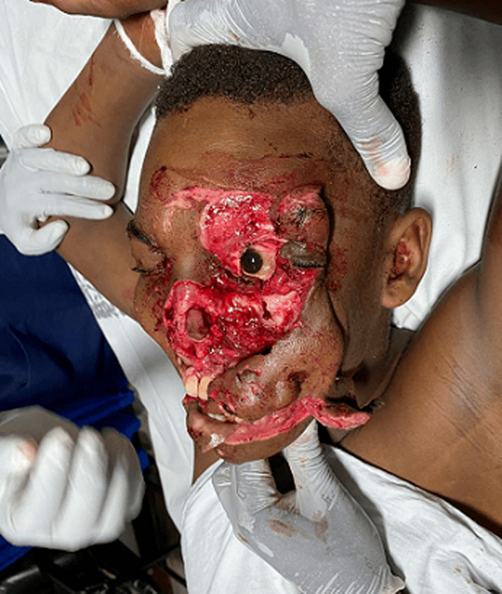 Clinical photograph of the patient lying down with gloved hands supporting his head. The soft tissue of the forehead, nose, left cheek and lips is torn and peeled back, exposing the tissue underneath, while the left eye remains in place.