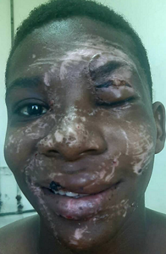 Clinical photograph of the same patient facing the camera after the stitches were removed. The facial features are back in their normal positions, with pale healing lines across the forehead, nose, cheeks, lips and chin, and the left eyelids still swollen.