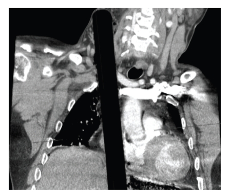 A coronal CT scan of the upper chest and neck. A long, straight, dark band, the wooden rod, runs vertically up through the chest beside the heart and into the right side of the neck.