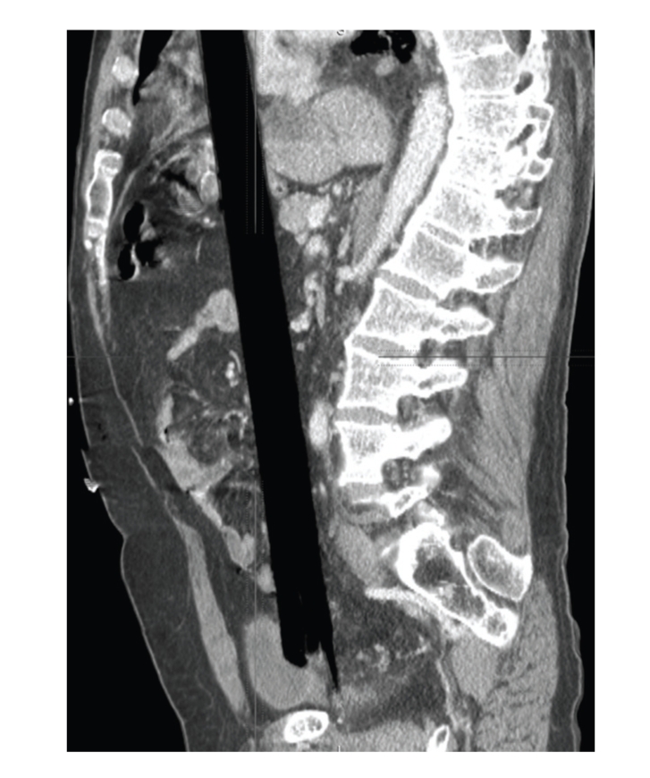 A side-view CT scan of the abdomen and pelvis. A long, straight, black band, the wooden rod, runs from the bottom of the pelvis upward in front of the spine.