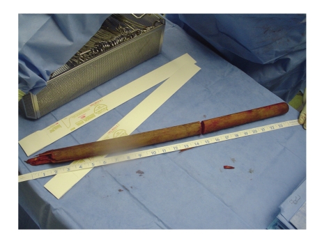 A wooden rod lying on a surgical drape beside a tape measure, cut in two, with a splintered, blood-stained end on the left.