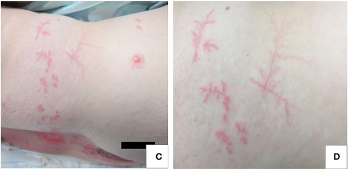 Two close-up photographs of pale skin on the side of the torso, covered in thin red lines that branch repeatedly, like ferns or lightning bolts.