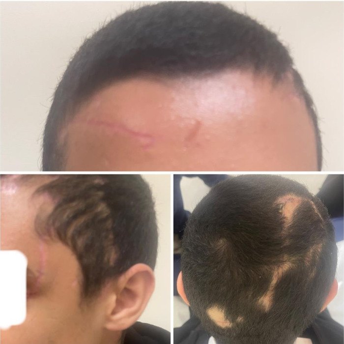 Three photographs of a young man's head with short dark hair regrowing: a healed scar on the forehead below the hairline, the side of the head with a faint scar near the temple, and the back of the head with a few small bald patches along healed scars.