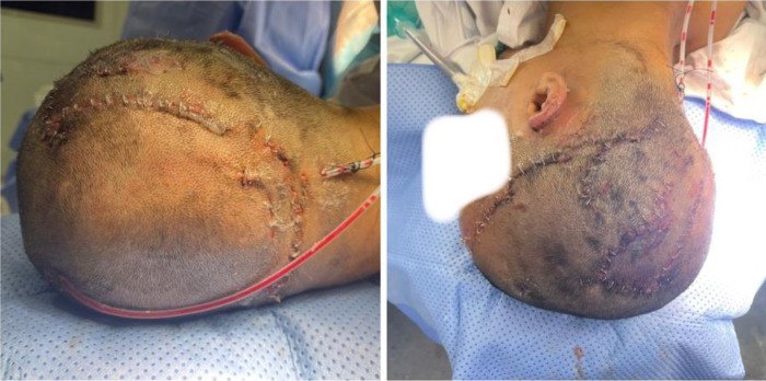Two photographs of a shaved head after surgery, seen from behind and from the side, with long curved lines of metal staples closing the scalp and a thin drain tube running from under the skin.