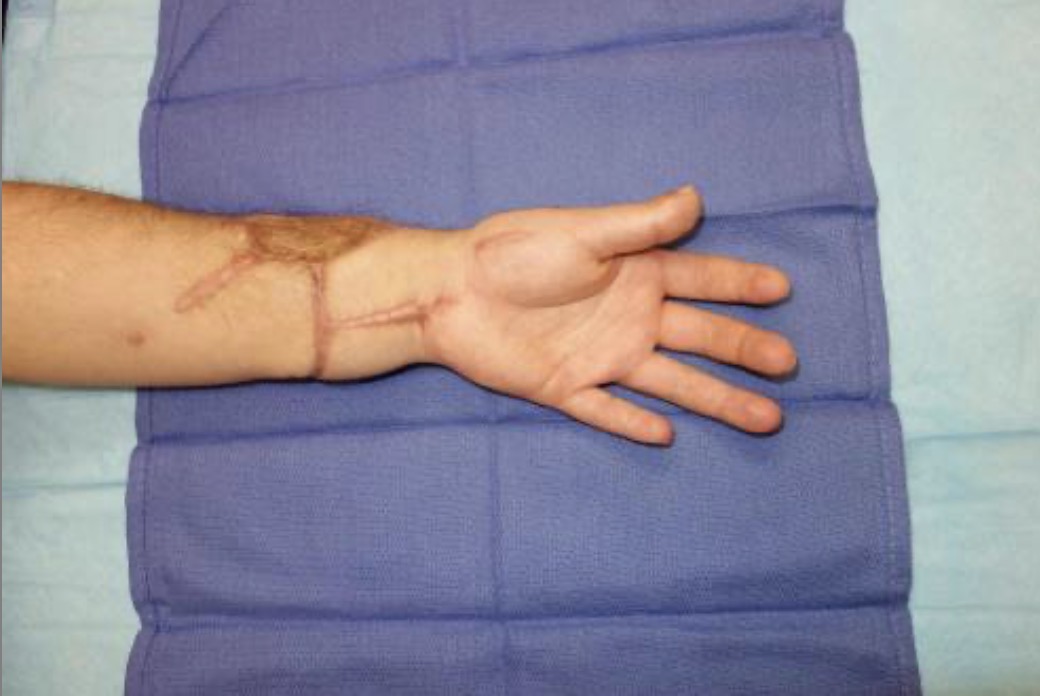 The replanted left forearm and hand at follow-up. The hand is open and flat with the fingers fully extended, and the circumferential replantation scar has faded to a thin line around the distal forearm